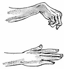 withered hand